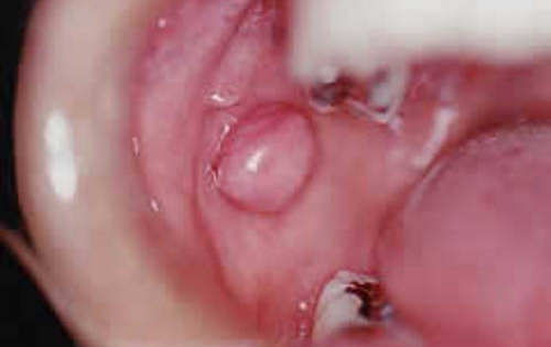 術前 右頬粘膜に弾性硬、拇指頭大の腫瘤を認める。食事中に奥歯で咬んでしまうこともある。
