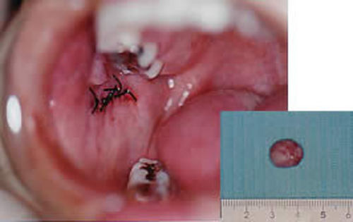 術直後 (摘出物) 腫瘍摘出直後。創部閉鎖は良好である。 右下写真は摘出された腫瘍。