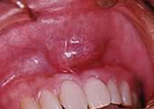 術前 上顎前歯部歯肉頬移行部に可動性で半球状の膨隆(腫瘍)を認める。