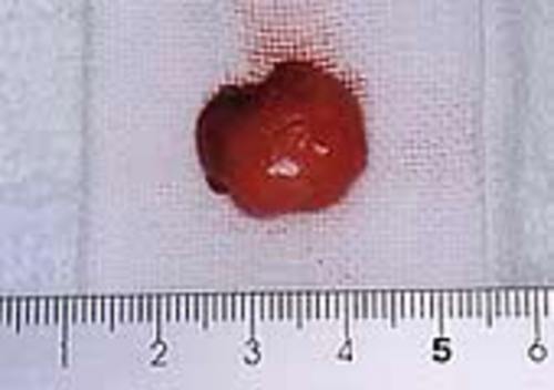摘出物 摘出直後の腫瘍。充実性で嚢胞様ではない。