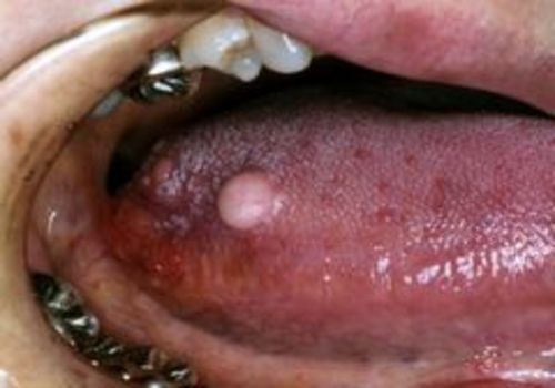 術前 右舌側縁部に小豆大の腫瘤生じる。周囲との境界は明瞭で徐々に増大傾向を呈す。