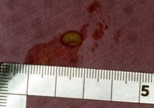 術直後 (摘出物) 摘出された腫瘍。弾性硬で一塊に摘出された。