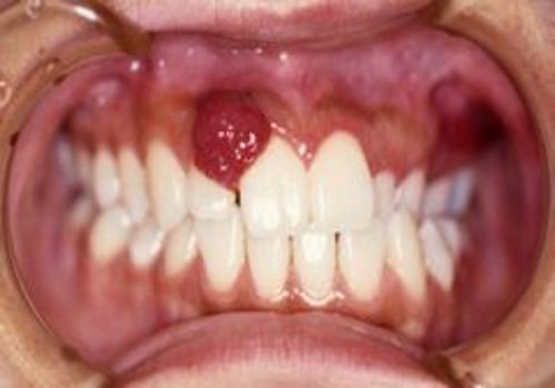 ＜5＞上顎前歯部に生じた血管腫性エプーリス