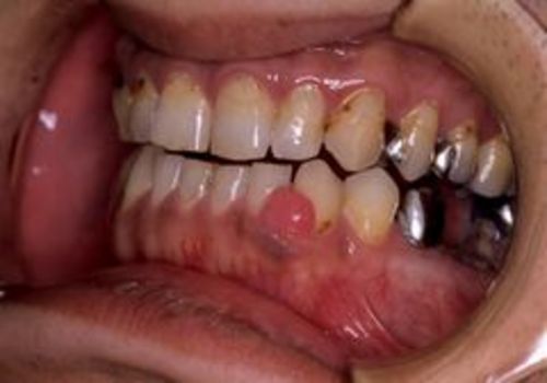 ＜6＞下顎前歯部に生じた線維性エプーリス