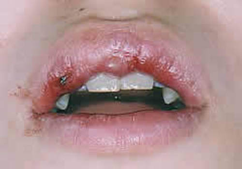 口腔外科症例 11 - ヘルペス性口内炎01