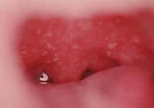 口腔外科症例 11 - ヘルペス性口内炎02