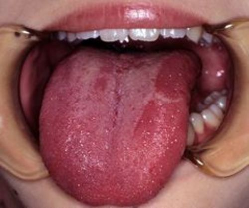 左舌背に生じた舌炎